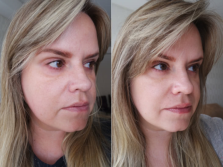 meu antes e depois do procedimento de lifting facial - Maquiagem para Noite